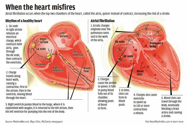 Atrial Fibrillation and Heart Failure: A Dangerous Duo