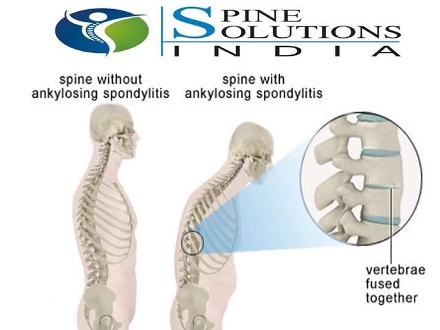 Coping with the Emotional Challenges of Ankylosing Spondylitis